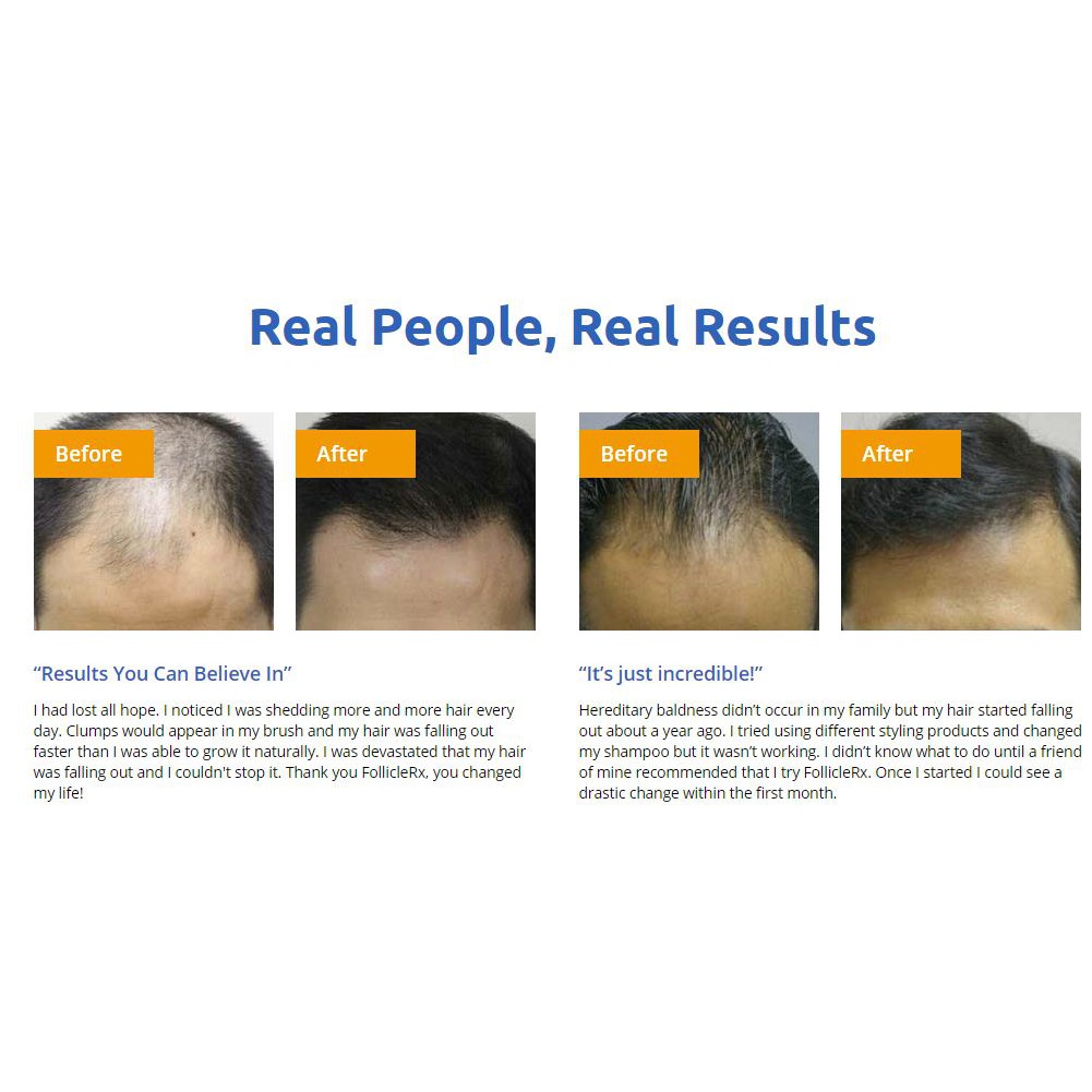 Follicle Rx for hair loss 60 Tab | Shopee Malaysia