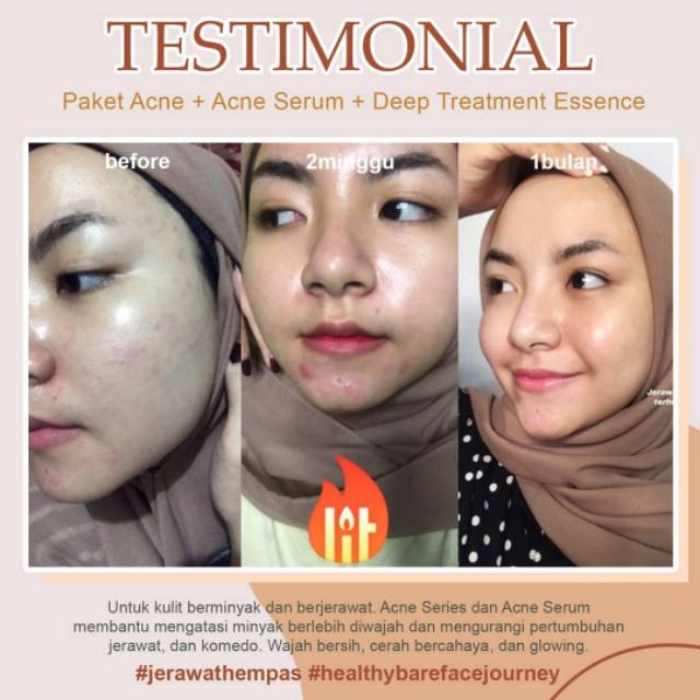 essence ms glow acne