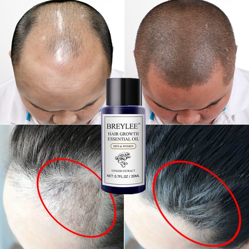 Breylee Hair Growth Essential Oil Bald Loss Nourishing Accelerate