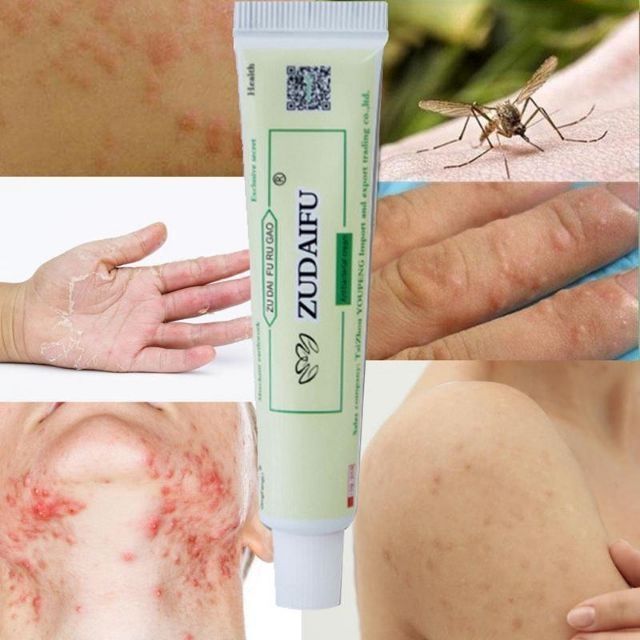 Krim masalah Ezcema/ Psoriasis/ Panau/ Gatal2/ Jerawat 