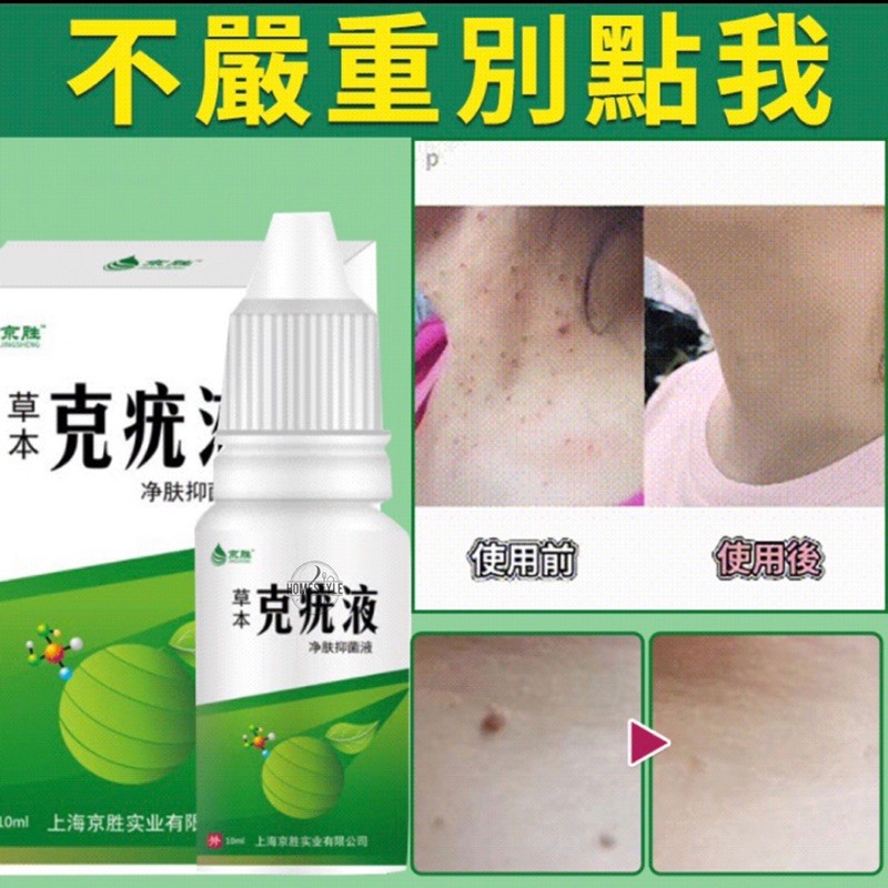 Selangor Post 京胜 克疣液去疣尖锐疣扁平疣肉刺疣去丝状疣克疣液Ke wart liquid to remove warts, flat warts, spur warts, to remove filamentous