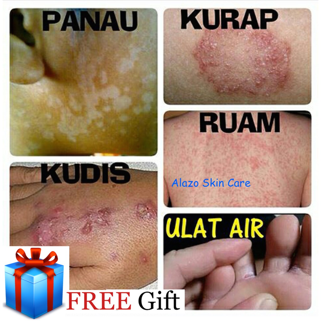 Ubat Kurap Gatal  Qiqi Spa x