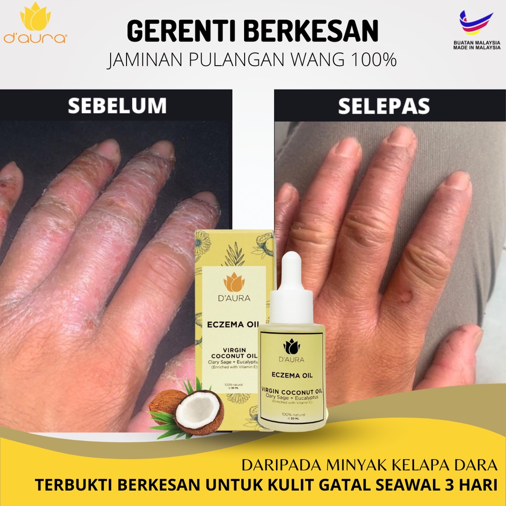 D'AURA ECZEMA OIL [ UBAT GATAL 100 SEMULAJADI ] UNTUK EKZEMA PSORIASIS