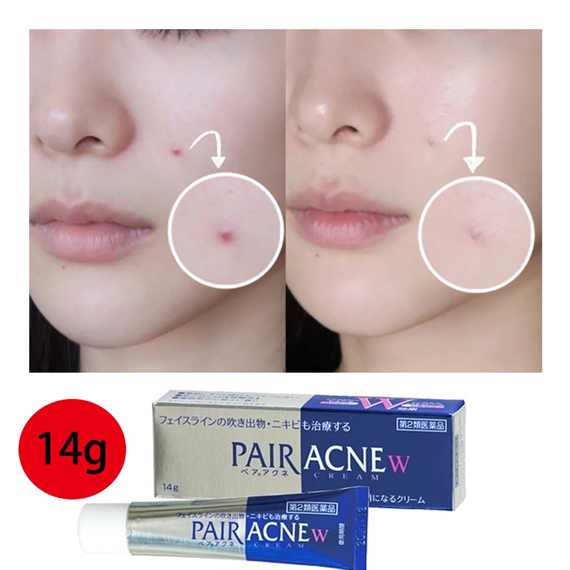 review pair acne cream