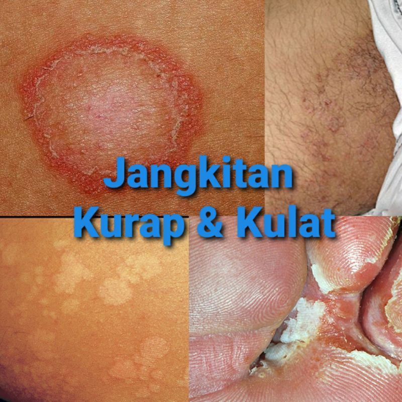 Krim Ubat Gatal Kurap Kulat Fungus Makan Air Panau Gatal Celah Kangkang Shopee Malaysia