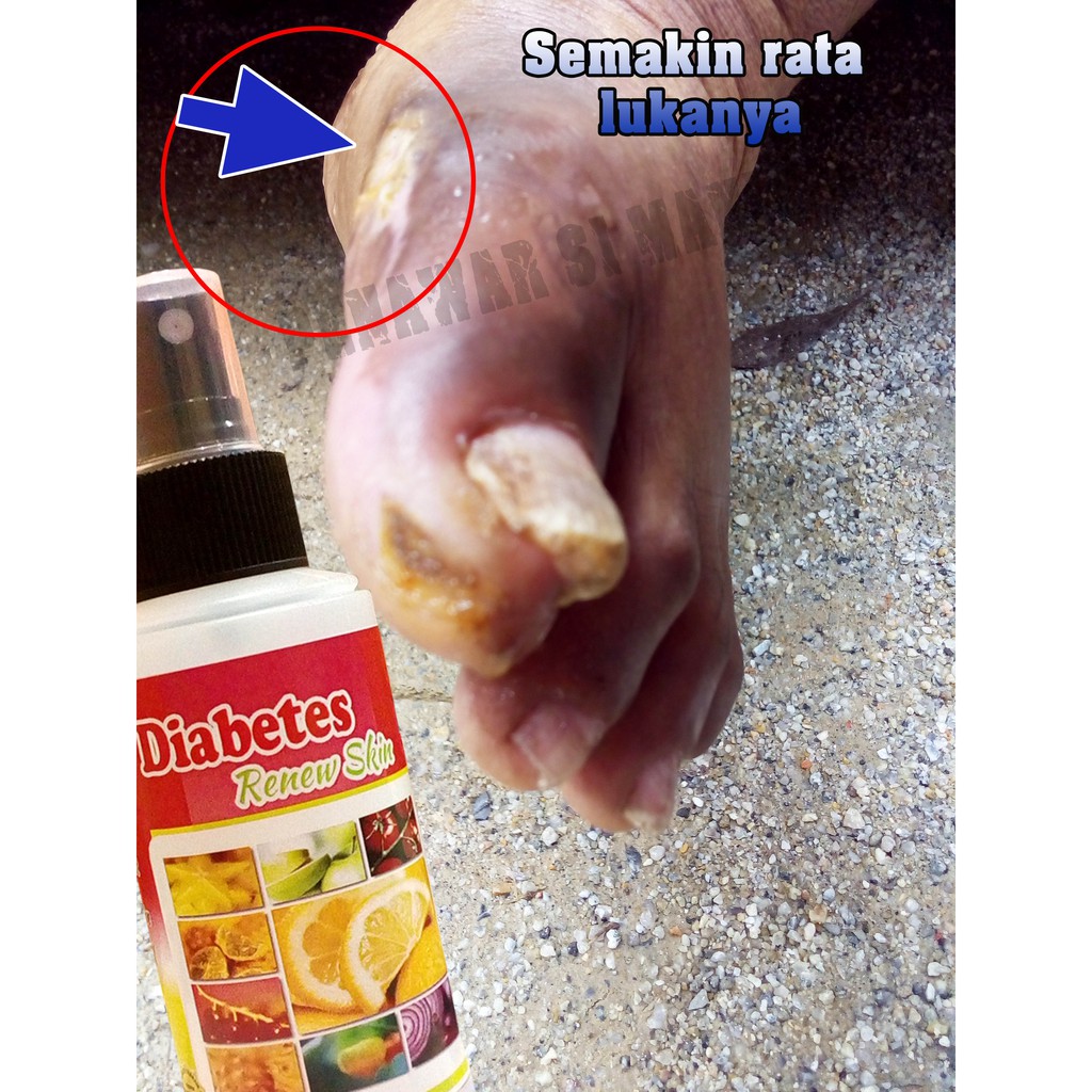 AzfaRich Penawar Luka Kencing Manis - Diabetes Renew Skin 