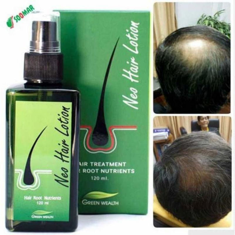 Neo Hair Lotion Orignal Spray Hair Transplant and Hair Loss Treatment