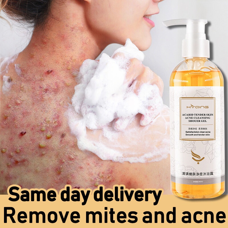 Acne body wash ubat mandian badan Whitening Back acne sabun badan Acid