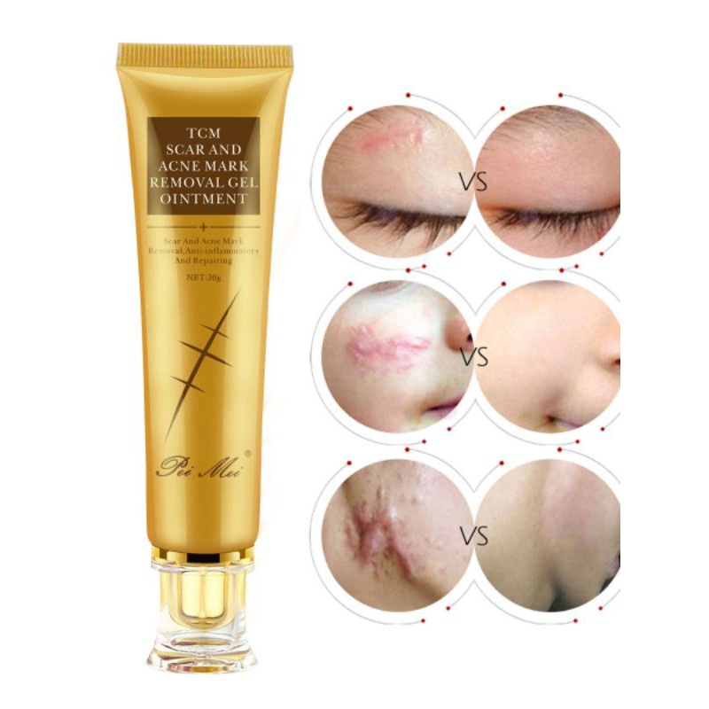 TCM SCAR AND ACNE Cream MARK REMOVAL GEL Repair Ointment/Hilangkan