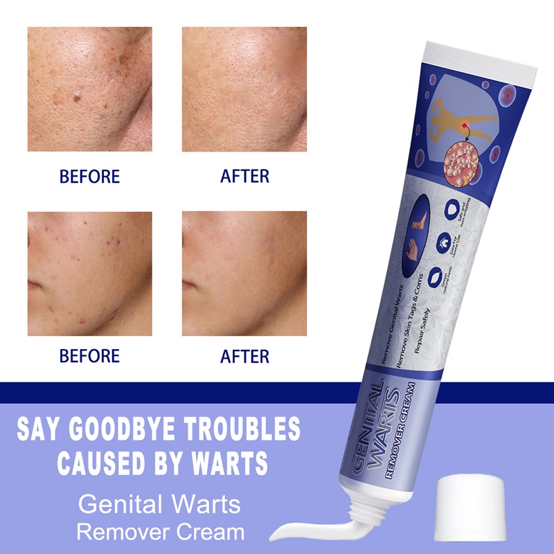 Skin Tag Remover Genital Warts Removal Cream Kutil Removal Tahi Lalat