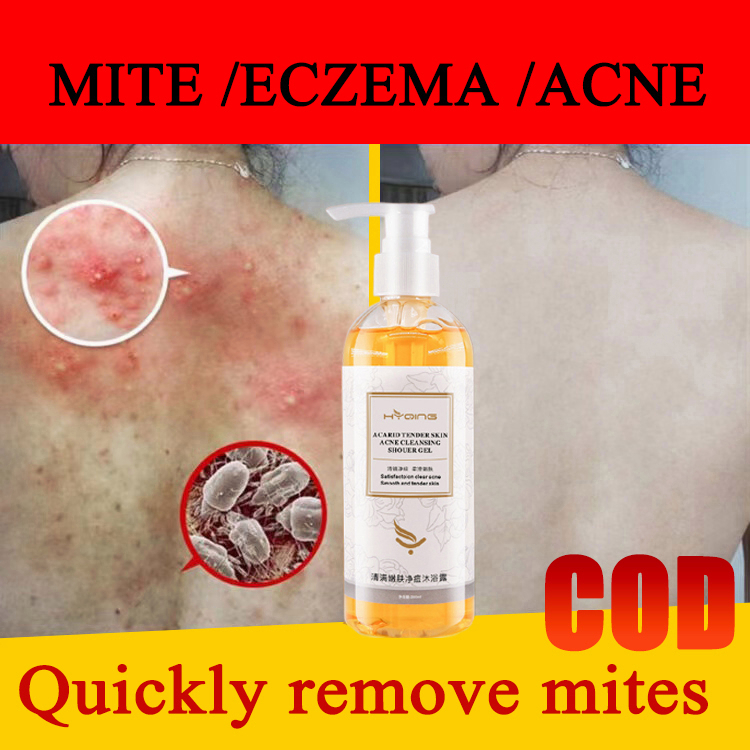 acne body wash eczema body wash quickly remove back acne Eczema Kulit