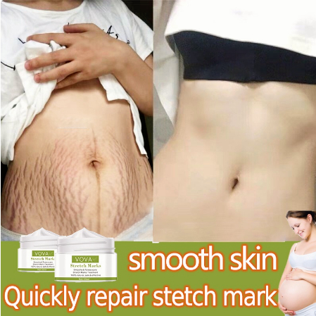 stretch mark cream stretch mark Krim Stretch Mark Safe, halal, natural maternity skincare products for pregnant women