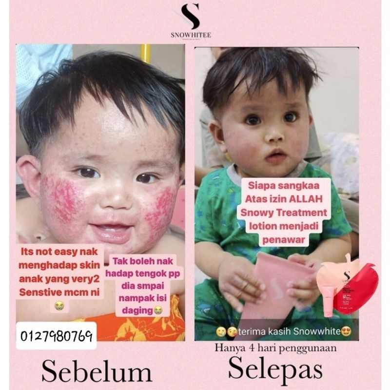 💢 HOT PRODUCT!! 🎁 + Cream Ubat Eczema Budak Baby Bayi Sakit Kulit Gatal Elergic Cream Lotion Snowy White Susu Unta
