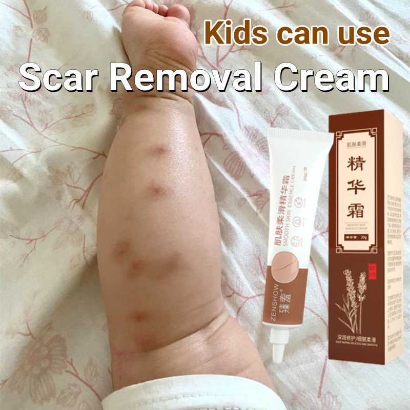 hilangkan parut bayi krim parut kaki remove scar ubat parut jerawat acne scar removal cream menghilangkan parut