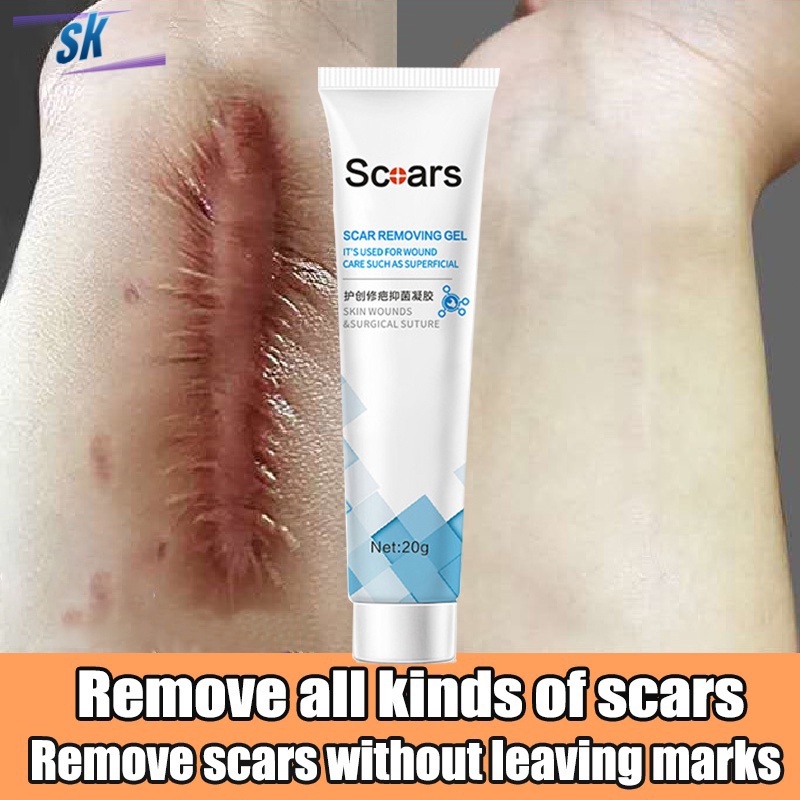 Scar Removal Cream Treatment Remove Stretch Marks ubat hilangkan parut jerawat Acne Scar Serum Burns Scald Repair 祛疤膏