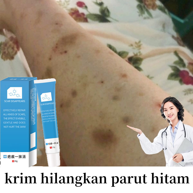 krim hilangkan parut hitam Menghilangkan bekas luka lama Ubat parut kaki Mosquito bite scar Keloid scar Burns Scald scar