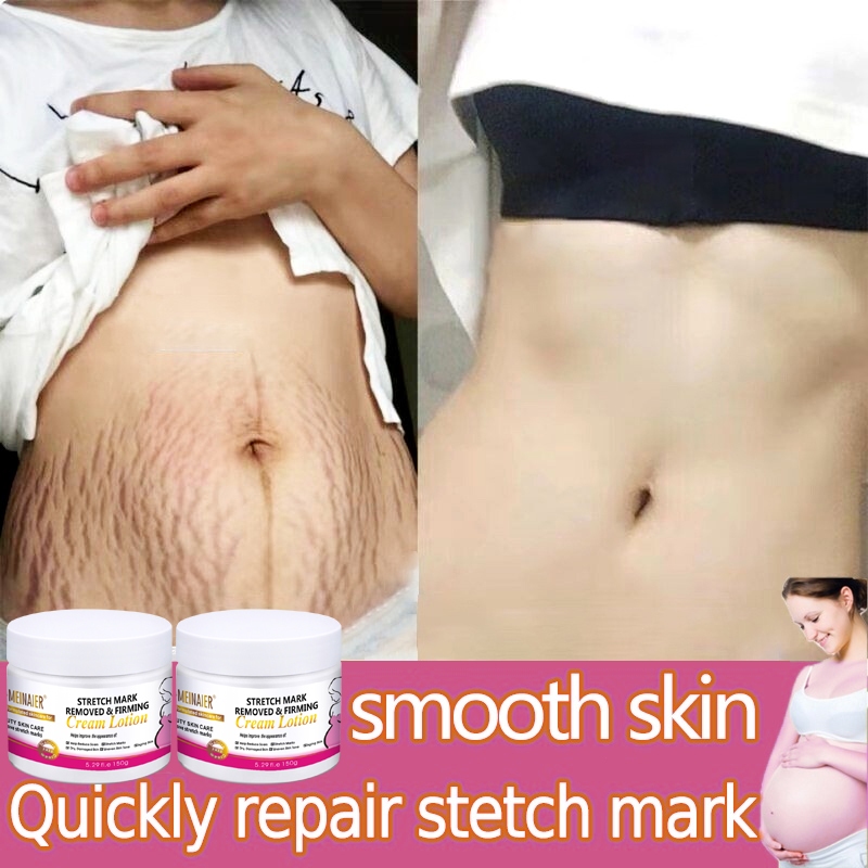 Stretch Mark Cream scar removal cream 150g Halal Safety Remove Breast Waist Abdomen Buttocks Stretch Marks Maternity Care