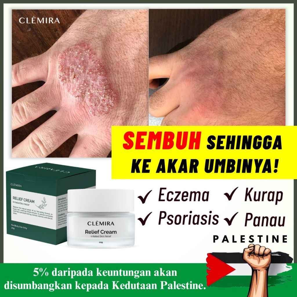 Clemira Relief Cream Ekzema Ubat Gatal Kulit Panau Kurap Ubat Gatal Krim Gatal Eczema Psoriasis