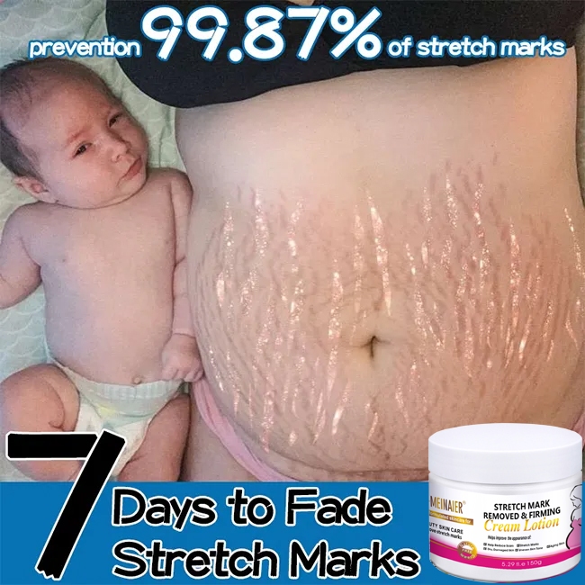 Strech Mark Cream-Stretch Mark Cream- stretch mark 150g natural herbs Repair Stretch Mark Anti Stretch Mark