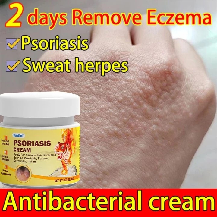 Psoriasis Antifungal Cream For Skin Itchy Eczema Cream Gatal Kulit 20g Krim Gatal Kulit Herba Cina Ubat Gatal