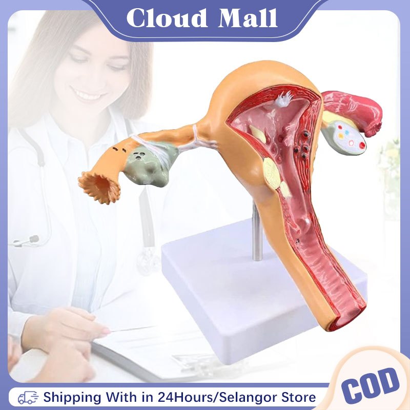 Uterus Model Pathological Uterus Ovary Anatomical Model Ovary Anatomy Cross Section Study Tool