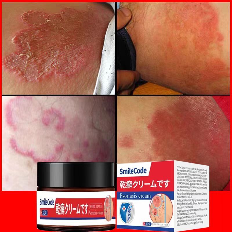 [100%effective] Eczema Psoriasis Cream Antibacterial Anti Itch Relief Antifungal Cream gatal krim gatal kulit 30g
