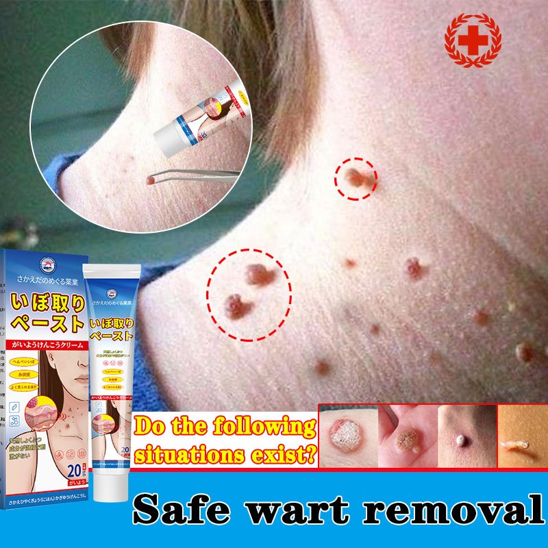 Japan Wart Removal Cream Ubat buang kutil ketuat tahi lalat biji kolestrol krim ketuat dan kutil Skin Tags Remover 去疣膏
