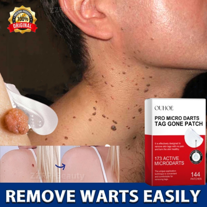 Wart Remover Patch 144pcs/box ubat kutil tahi lalat ketuat dan biji kolesterol skin tag remover corns treatment