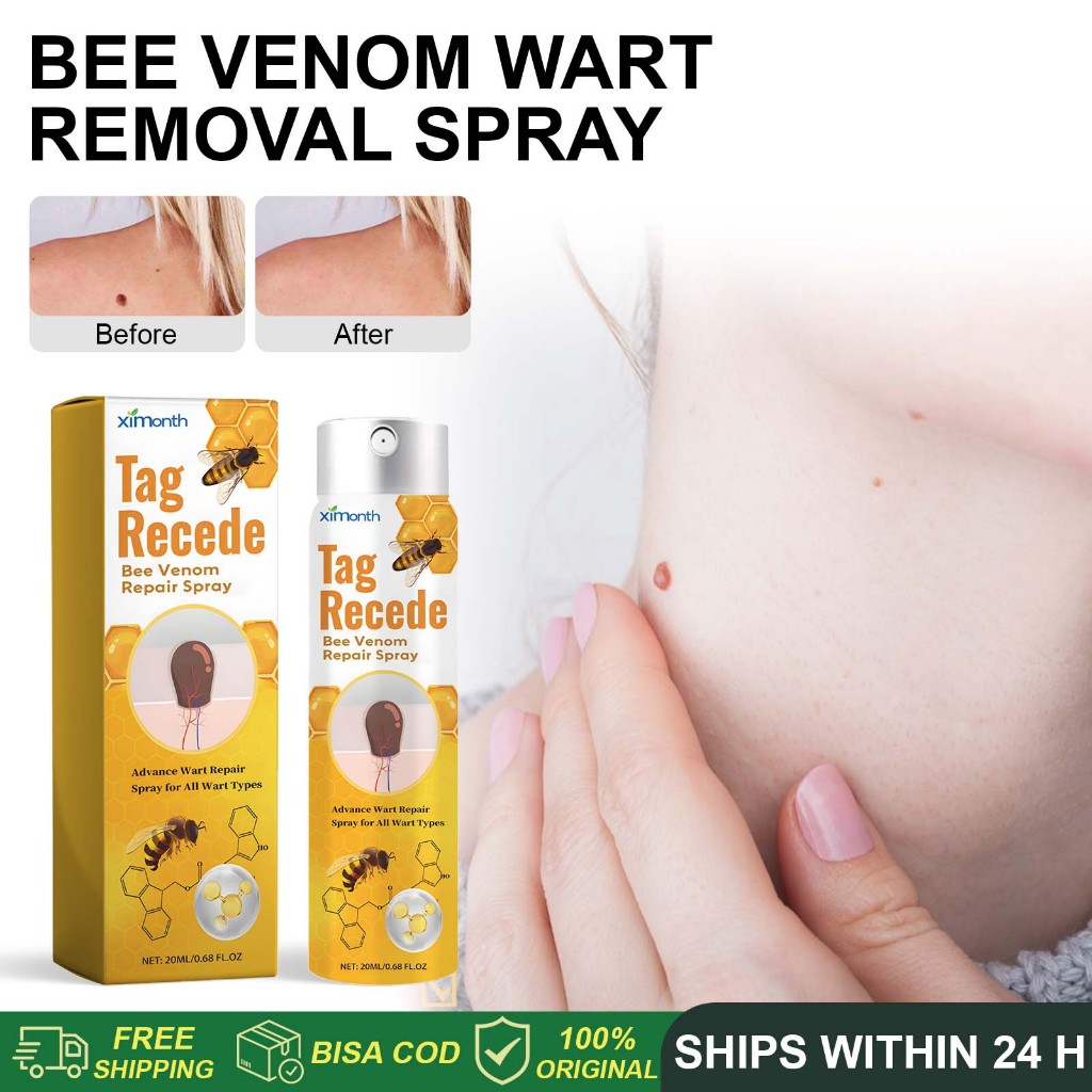 Bee Venom Wart Removal Spray 20ml Skin Tags Removal Skin tag remover Buang tahi lalat Ubat ketuat Corn Mole Remover