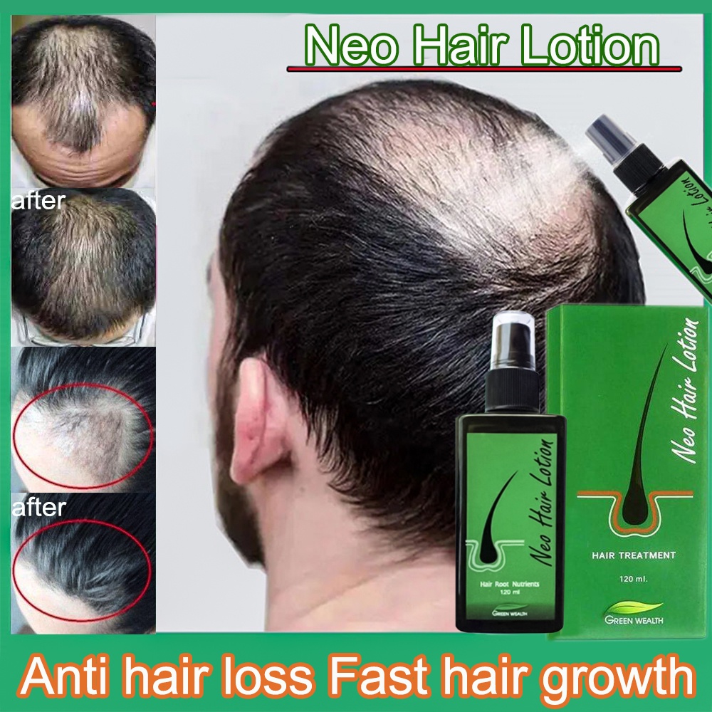 Neo Hair Lotion Tonic Growth Lotion Haircare Hair Loss Treatment Hair  Thinning Hair Oil Hair Care Promote Hair Growth | Shopee Malaysia
