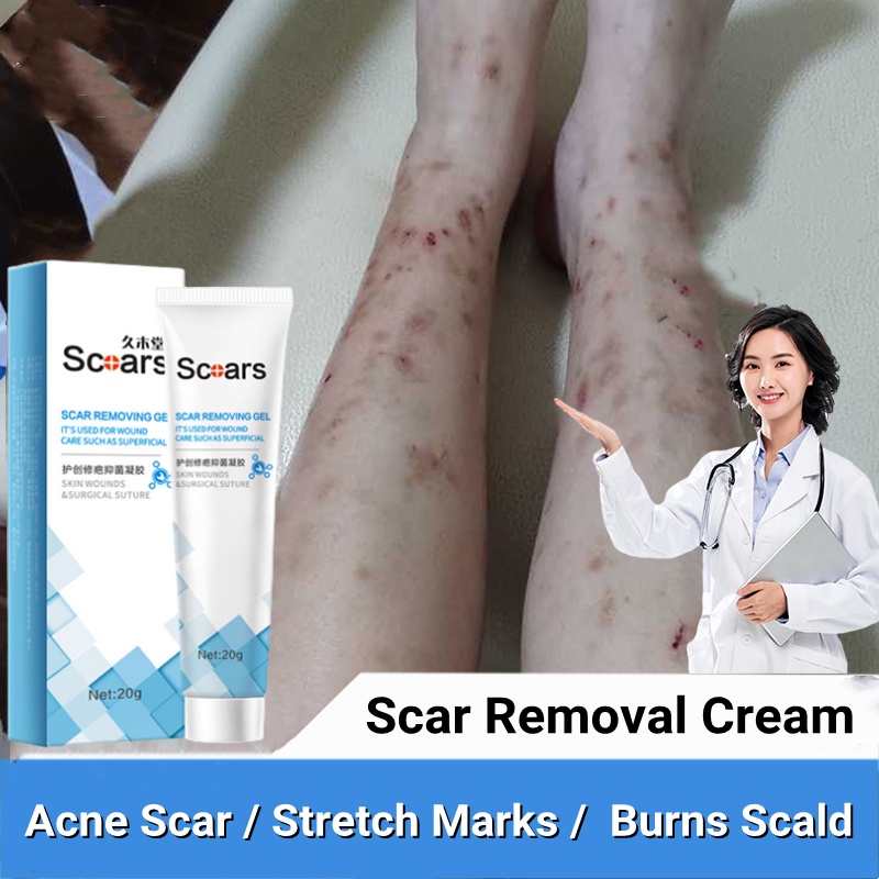 Scar Removal Cream Scar Repair Stretch Marks Burns Old Scars Scald Cesarean parut Repair ubat krim hilangkan parut祛疤膏