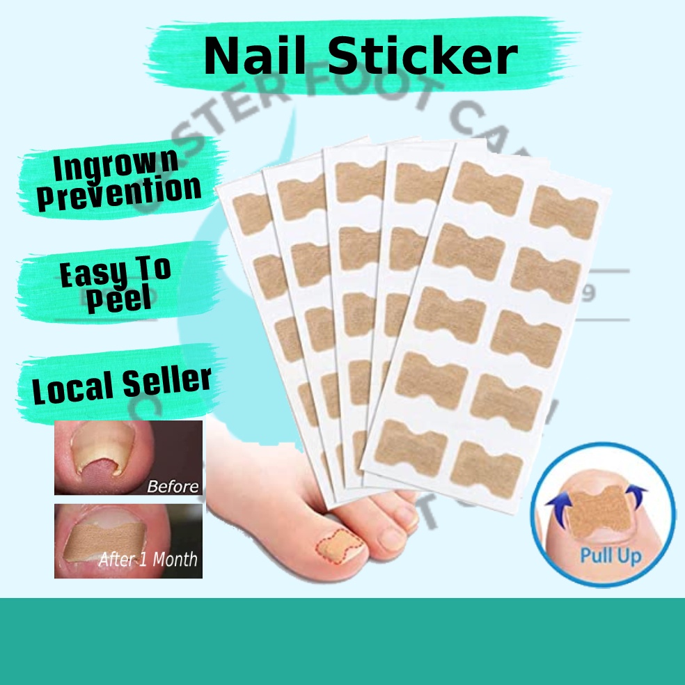 10 pcs Ingrown Toenail Correction Stickers, Elastic Patch Curved