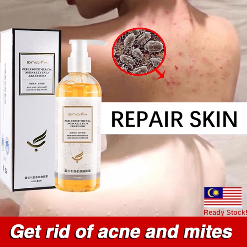 Antimite and acne shower gel Body Wash sabun jerawat badan hilang