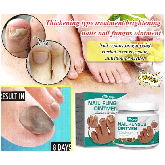 Thickening type treatment brightening nails nail fungus ointment
