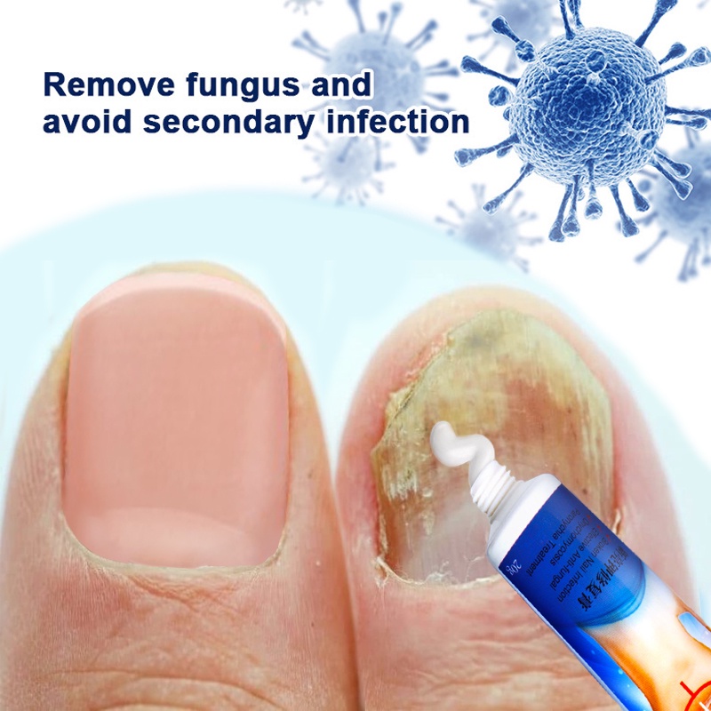 Nail cream nail fungus treatment anti fungal nail cream Krim KUKU Anti