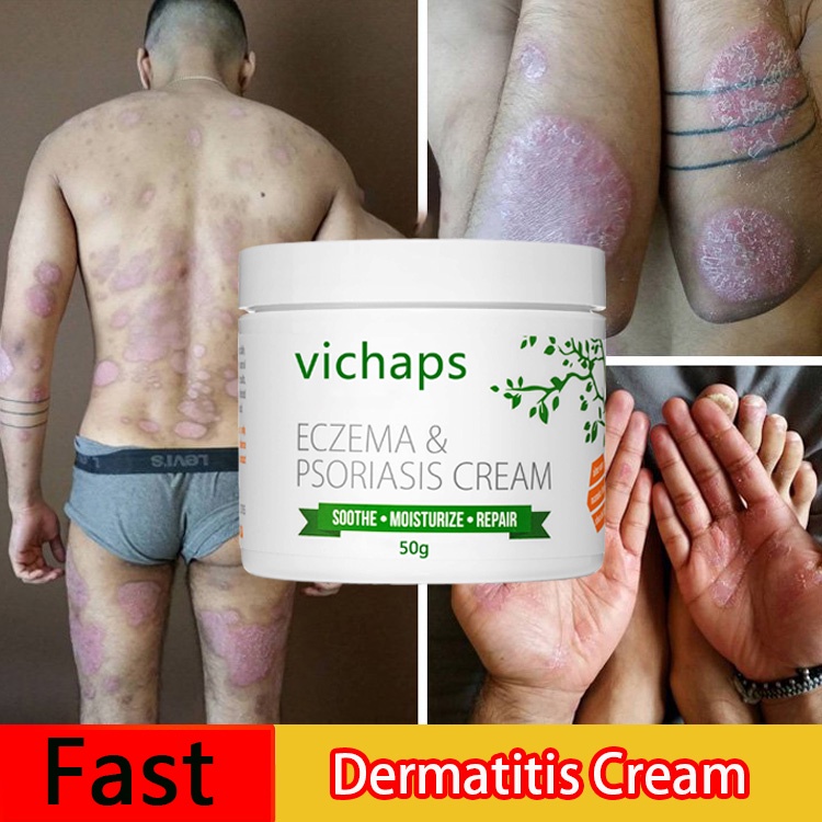 Psoriasis Treatment Cream with Herbal Ingredients for Psoriasis and