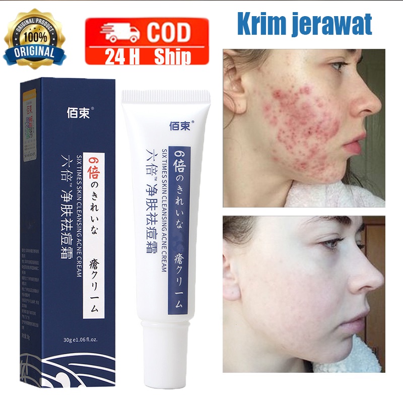 Repair Acne Cream Ubat Jerawat dan Parut Acne Pit Acne Scar Removal Facial Treatment Acne Treatment Whitening Skin Care