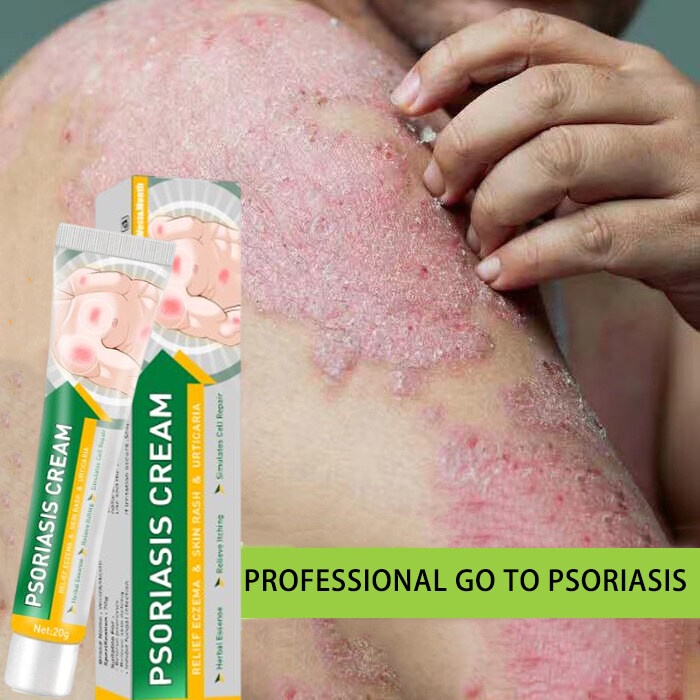 Psoriasis Cream Eczema Psoriasis Hand Foot Ringworm Sweating Herpes Urticaria Rash Scalp