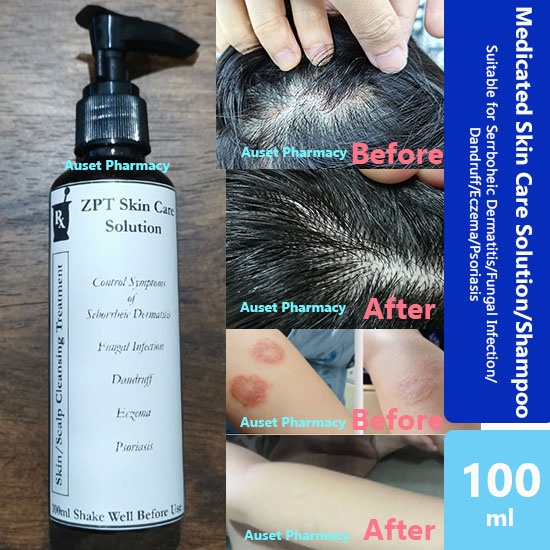 ZPT Skin Care Solution/Shampoo For Serrboheic Dermatitis/Fungal