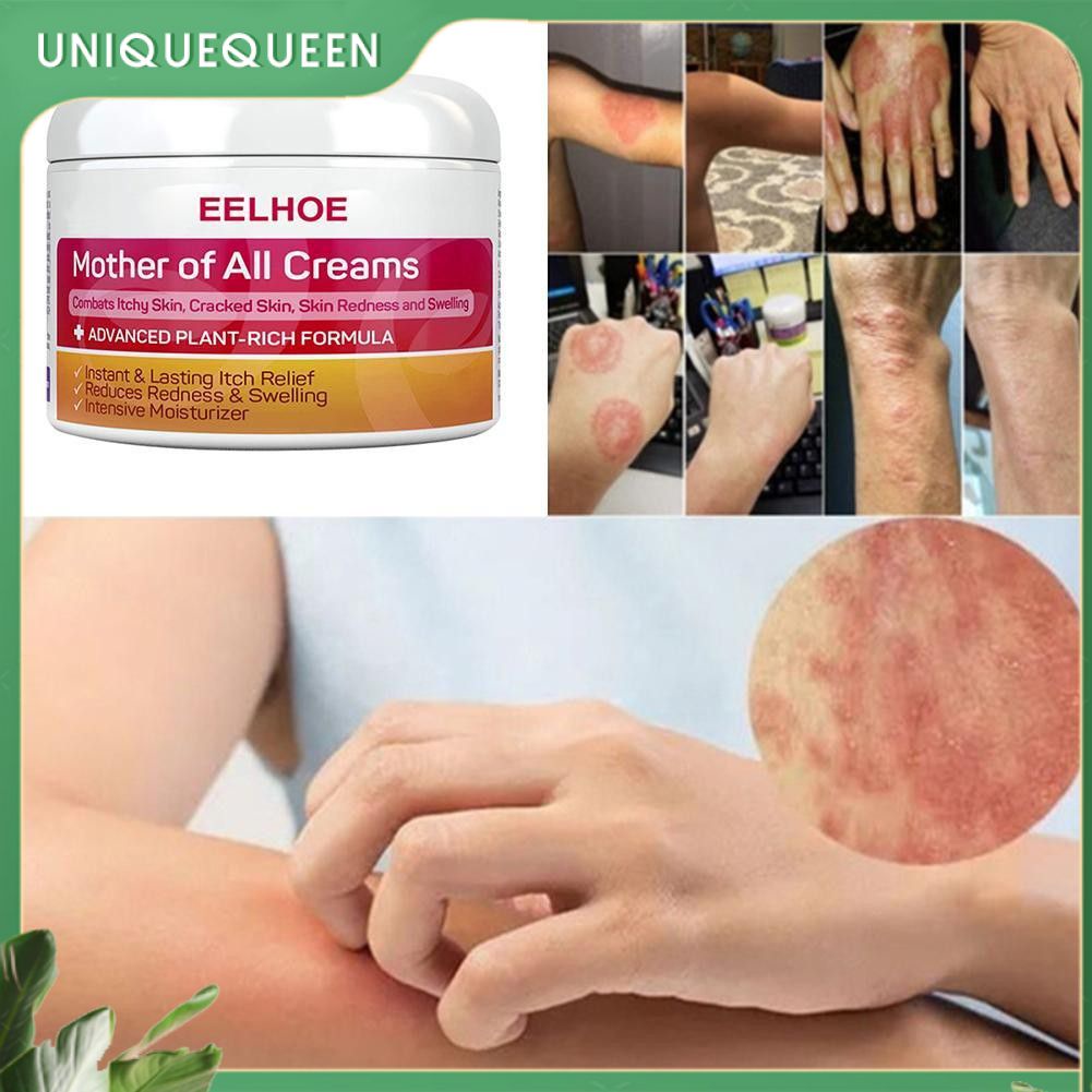 Eelhoe Eczema Cream Antiitch Cream Skin Topical Skin Repair Cream Skin