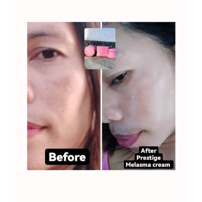 Prestige Melasma Cream 30g | Shopee Malaysia