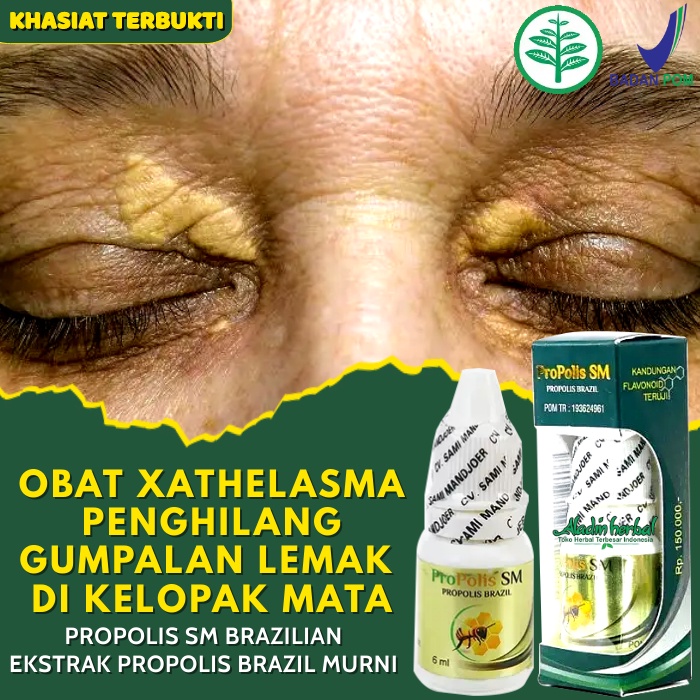 MATA Xanthelasma Medicine For Removing Fat Blemishes In The Eyes
