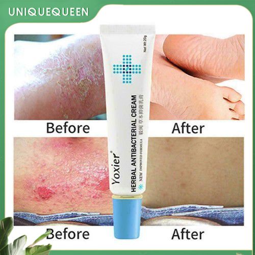 20g Yoxier Herbal Antibacterial Cream Psoriasis Antibacterial Cream 