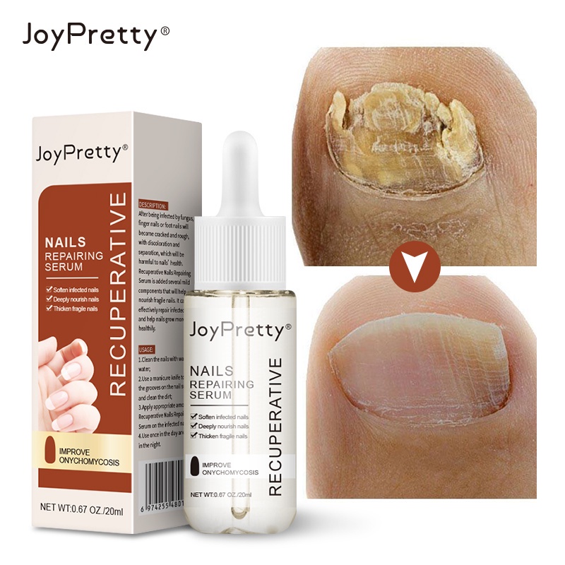 Must Durable Fungus-Free Nails & Toes: Revitalize Whiten JOYPRETTY Care Elixir! - Image 2