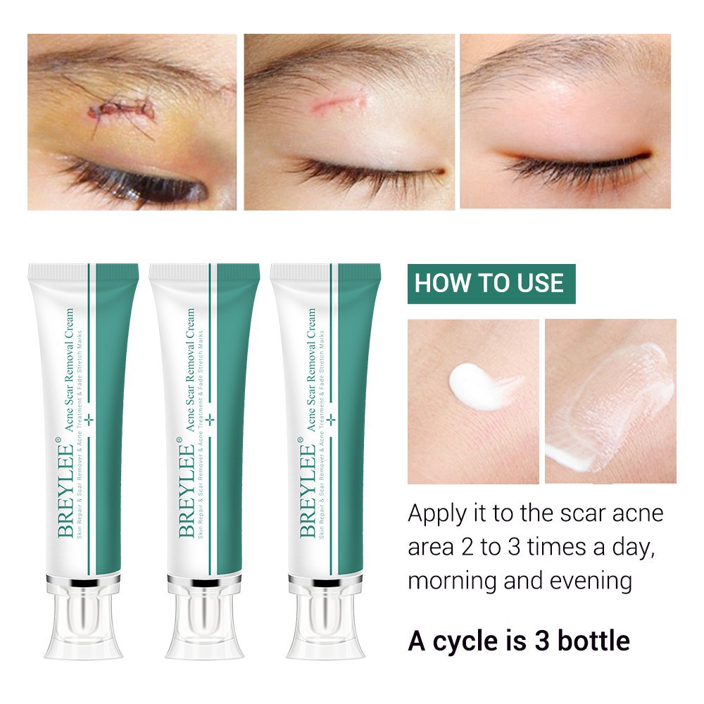 Essential Quality Ready stock ! BREYLEE Scar Removal Cream Treatment Remove Stretch Marks Whitening (30g) Versatile - Image 3