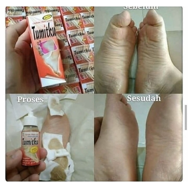 Durable Essential My Tumitku Overcoming Broken Legs Ship Instant 30ml Premium Reliable - Image 4