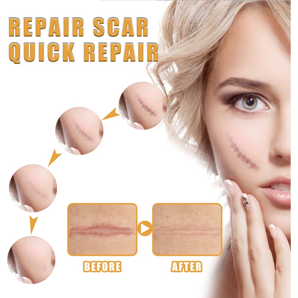 Durable Have Skin Scar Repair Cream Wounds Burn Desiccation Operation Premium - Image 4