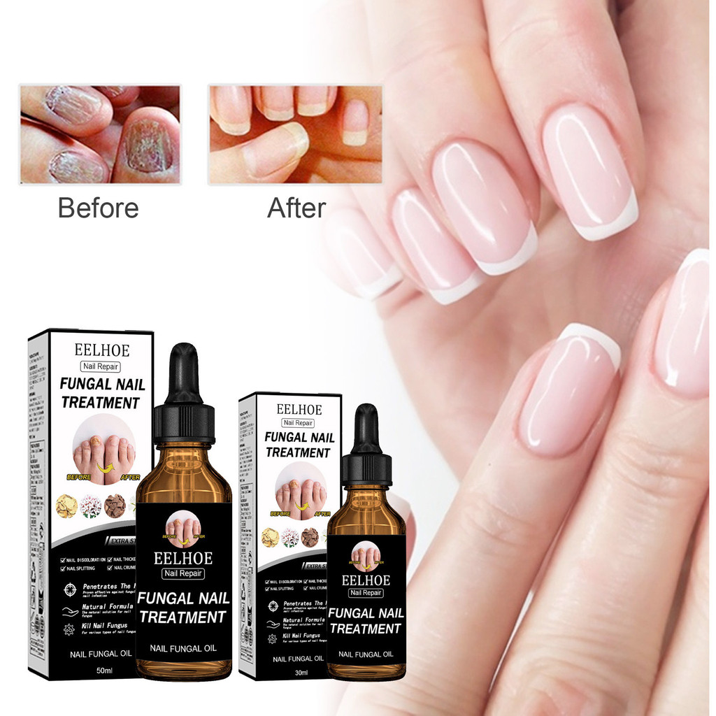 EELHOE Nail Repair Essence Removes Onychomycosis Serum Fungal Nail Treatment 30ml