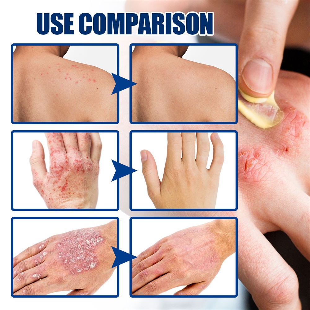 Durable Reliable South Moon Skin Therapy Healing Cream Relieve Itching Redness Dryness Repair Moss Moisturizing Ointm... - Image 4