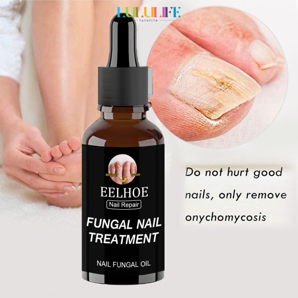 Eelhoe 30/50ml Treats Nail Mushrooms That Grow Back To The Original Decrease In The Growth Of Gray Essential Oil Tending Nails LULULIFE